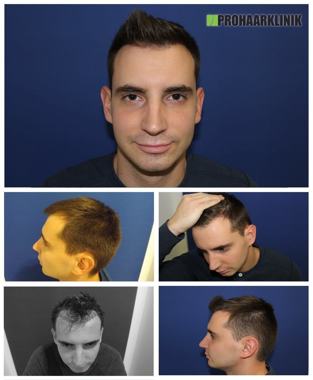 Haartransplantation Vorher Nachher