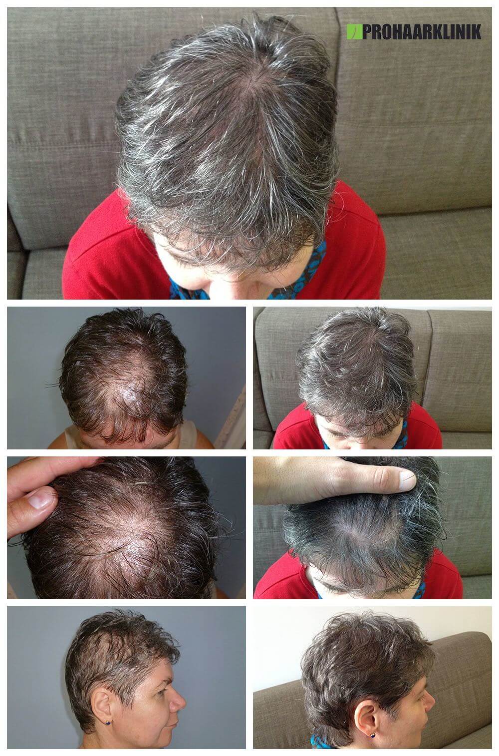 Haartransplantation Vorher Nachher