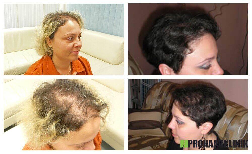 Haartransplantation Vorher Nachher