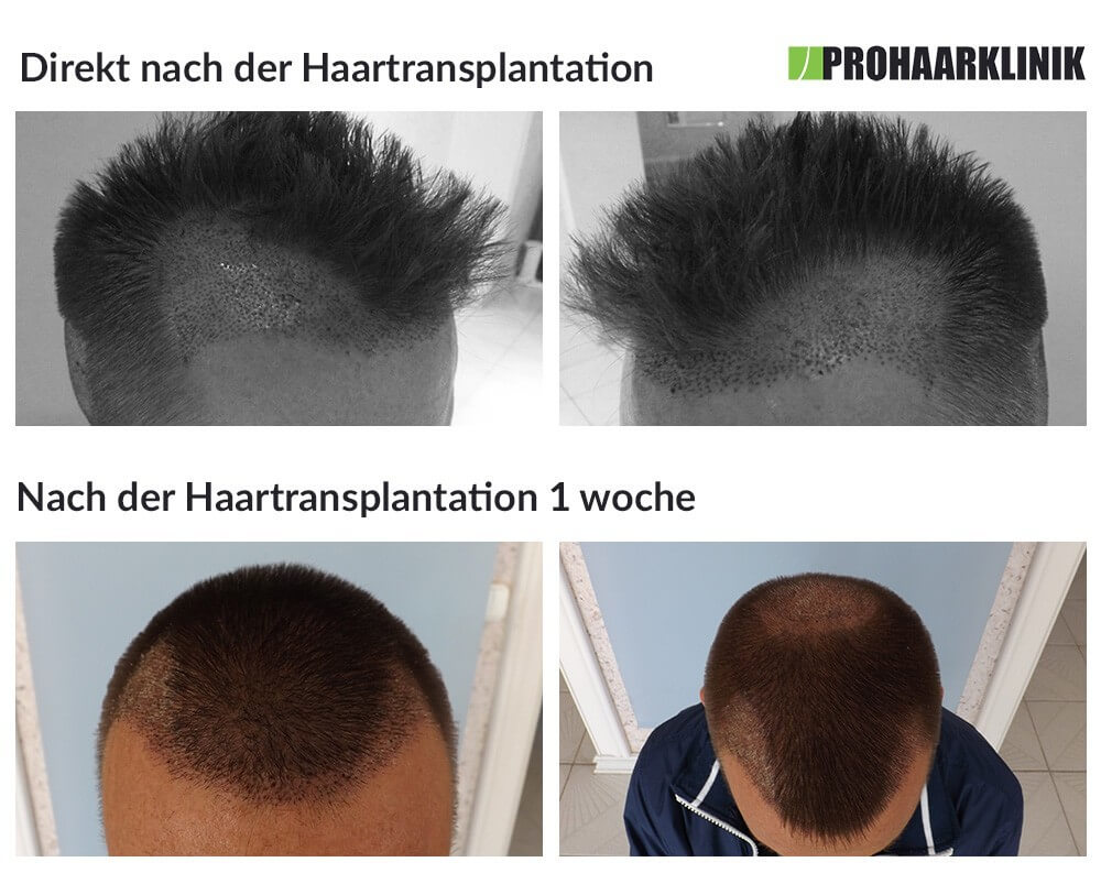Vorher Nacher Haartransplation Prohaarklinik Wien