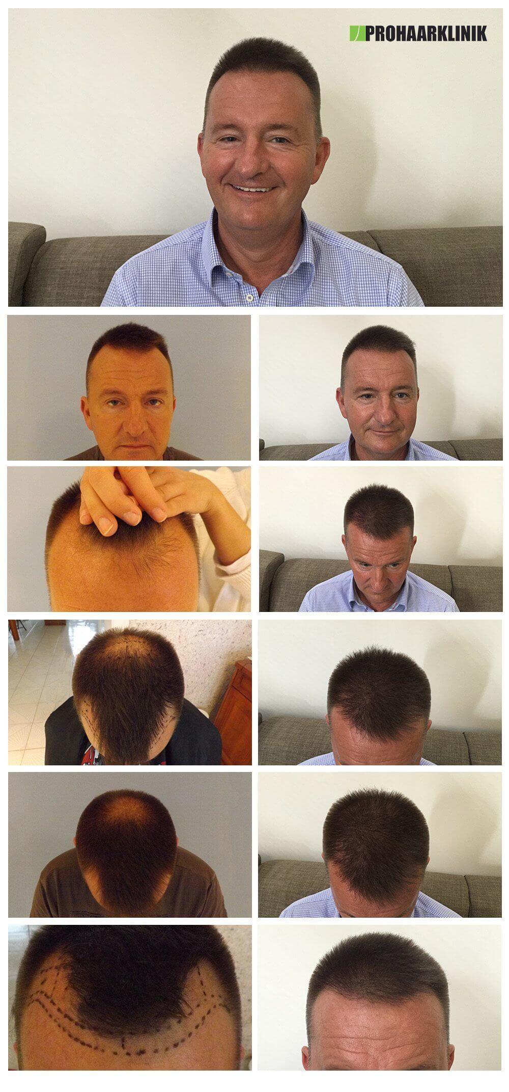 Haartransplantation Vorher Nachher