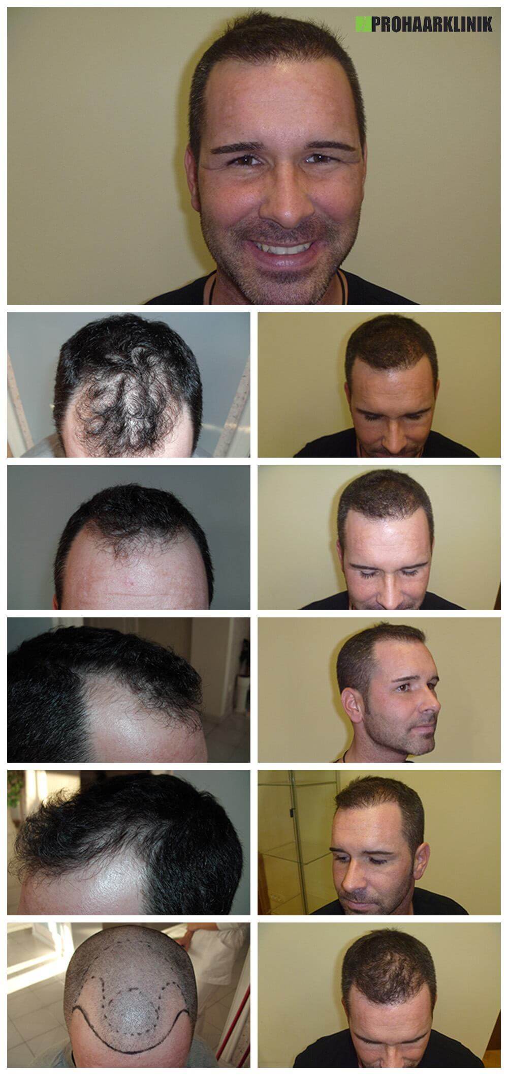 Haartransplantation Vorher Nachher