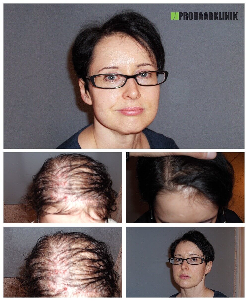 Haartransplantation Vorher Nachher