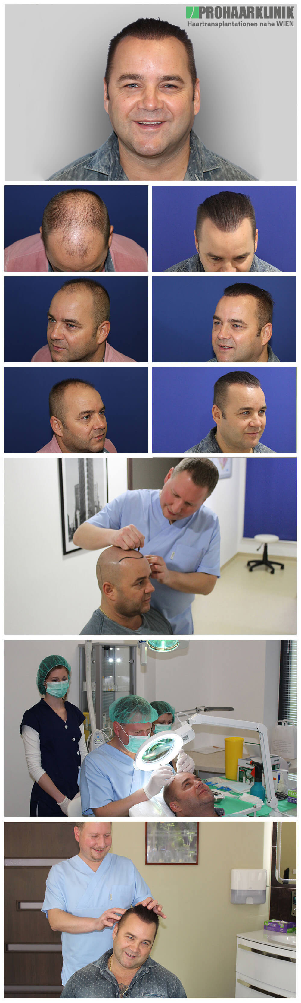 Haartransplantation Vorher Nachher