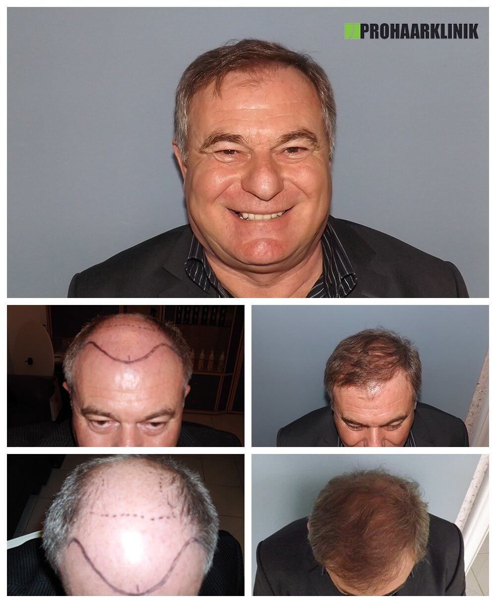 Haartransplantation Vorher Nachher