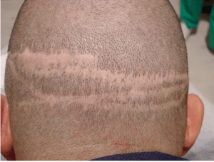 Fehler bei der Haartransplantation