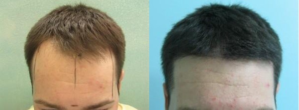 Fehler bei der Haartransplantation