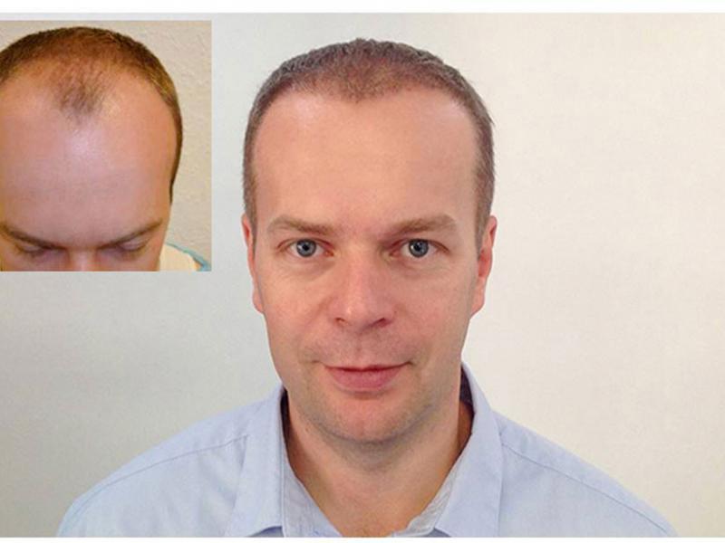 T. L. Haartransplantation Vorher Nacher Ergebnis Prohaarklinik Wien