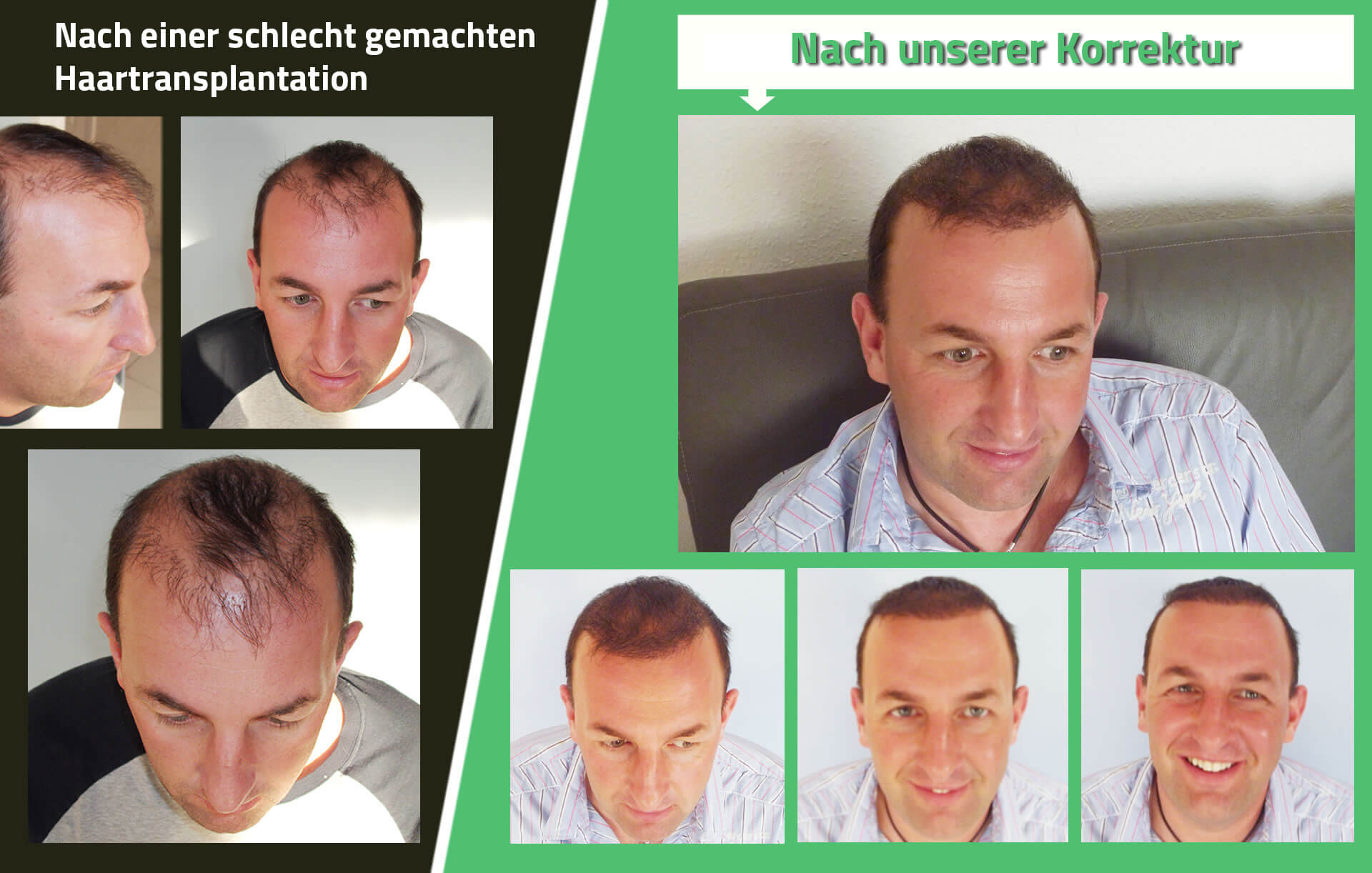 Fehler bei der Haartransplantation