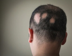 Alopecia areata