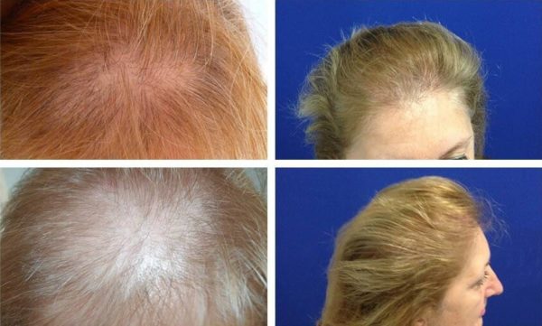 Die Fortschrittlichste Methode Der Haartransplantation Fur Frauen F U E 3 Prohaarklinik