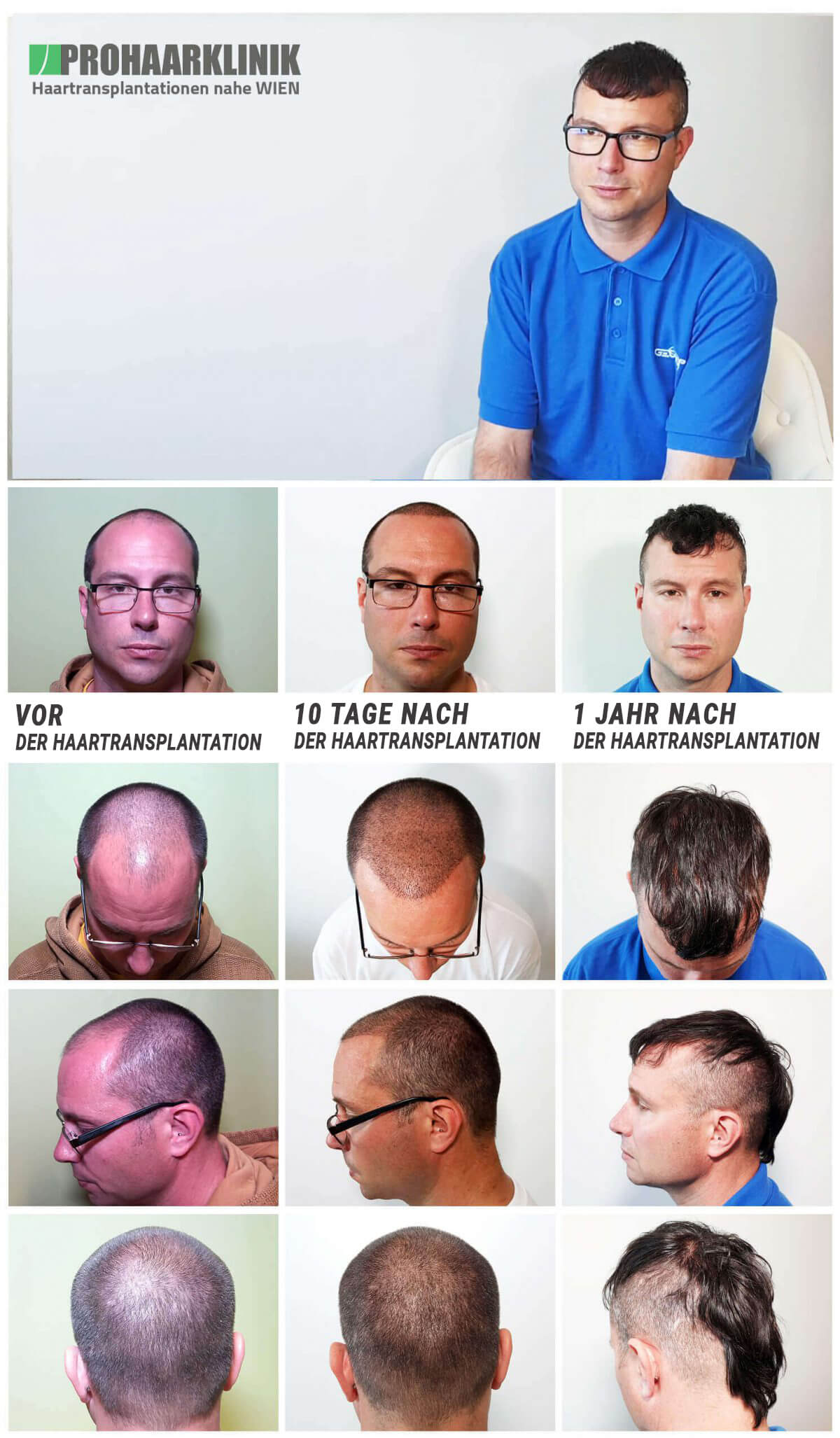 Haartransplantation Vorher Nachher