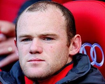 Vor der Haartransplantation – Rooney