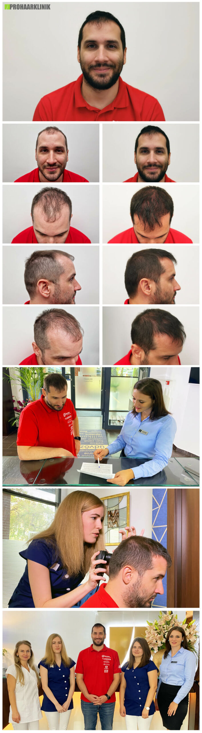 Haartransplantation vorher nachher - PROHAARKLINIK