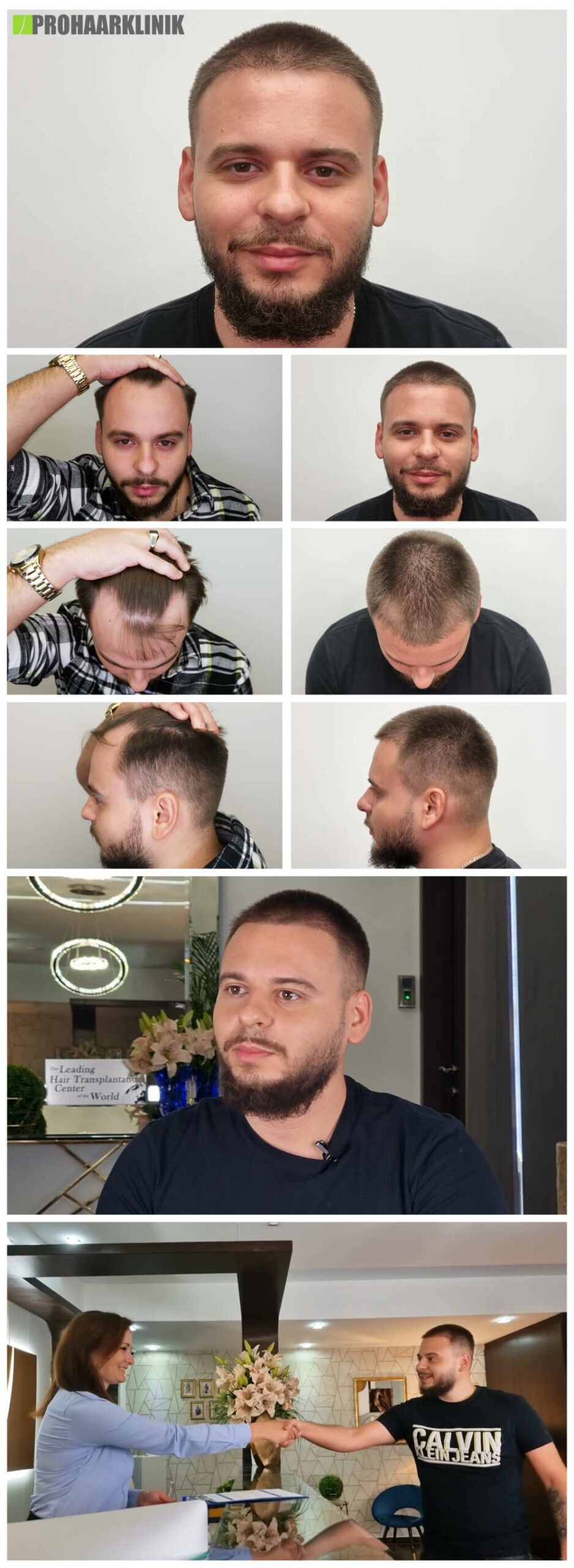 Haartransplantation vorher nachher Patrik Z - PROHAARKLINIK