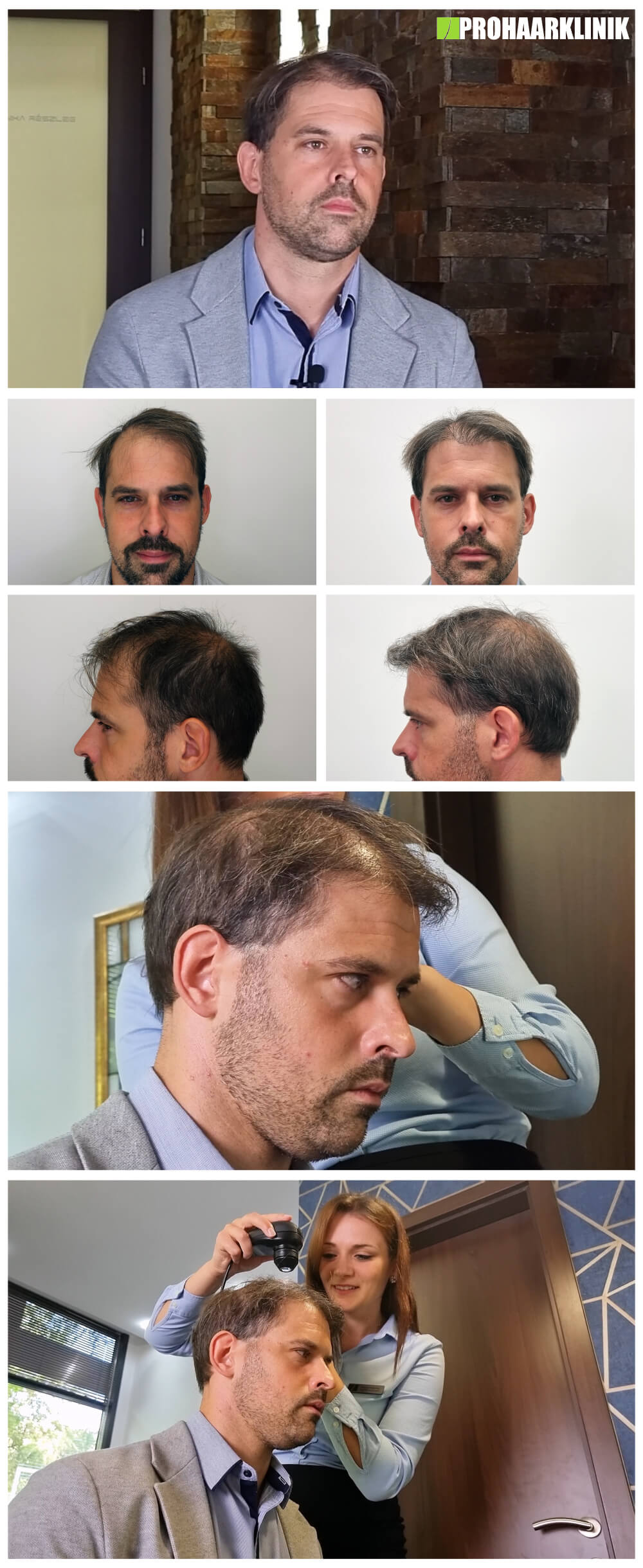 Haartransplantation Vorher Nachher