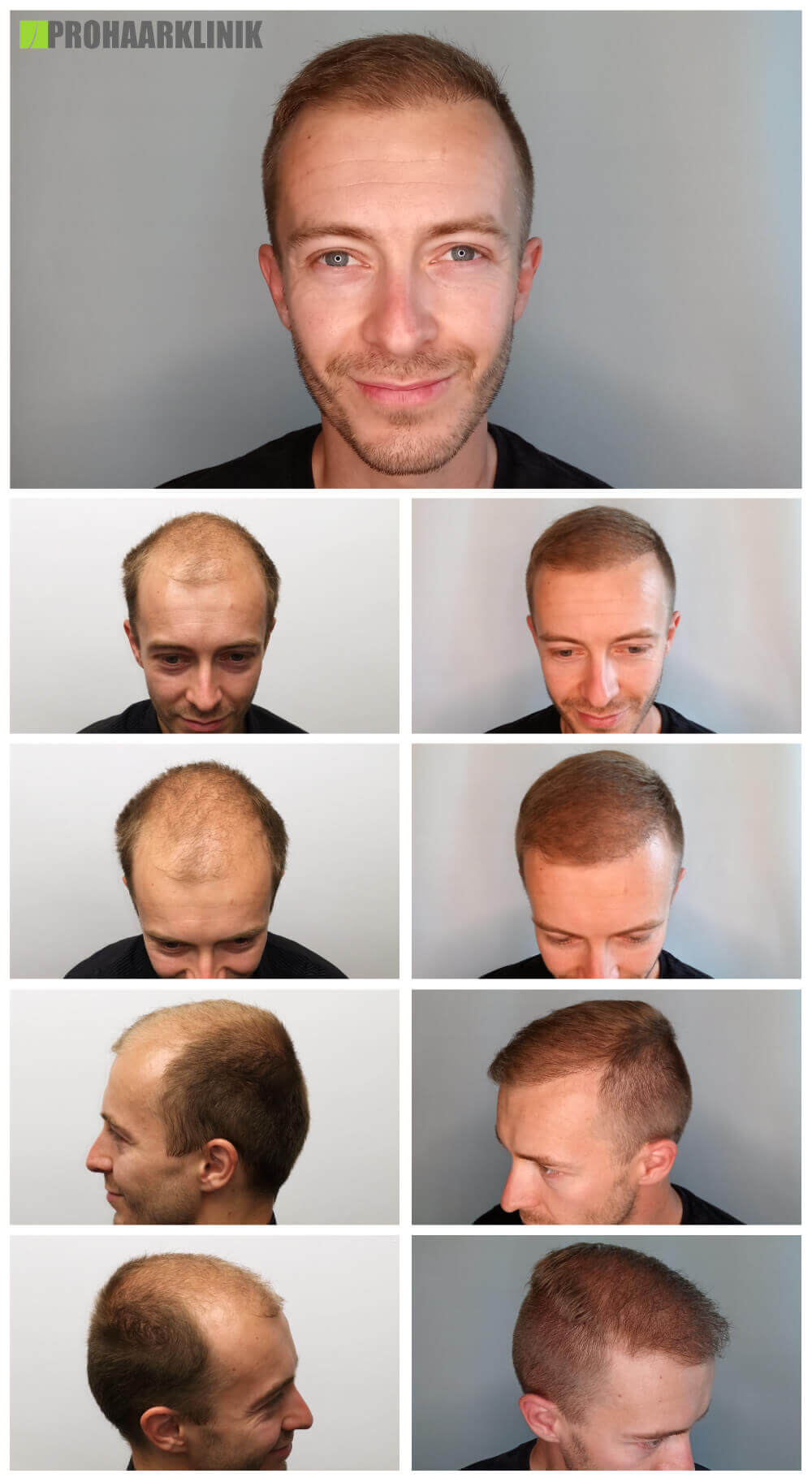 Haartransplantation vorher nachher - PROHAARKLINIK