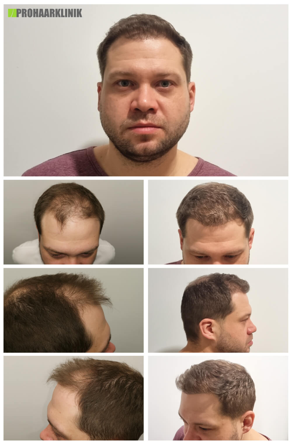 Haartransplantation vorher-nachher (Mate) - PROHAARKLINIK