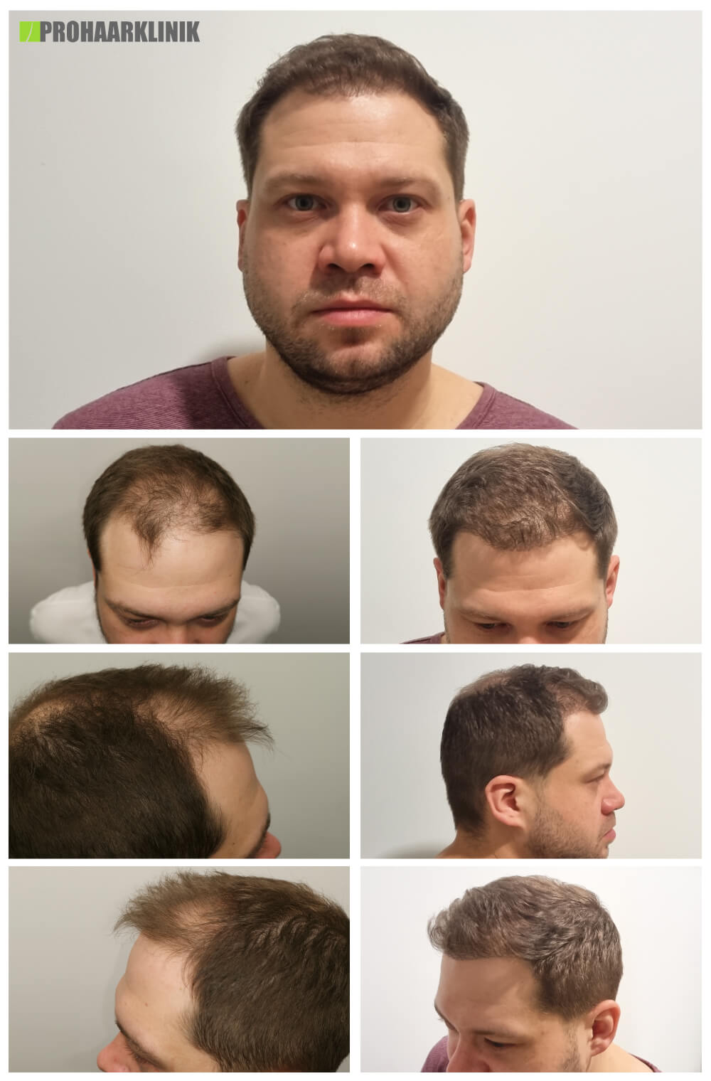 Haartransplantation Vorher Nachher