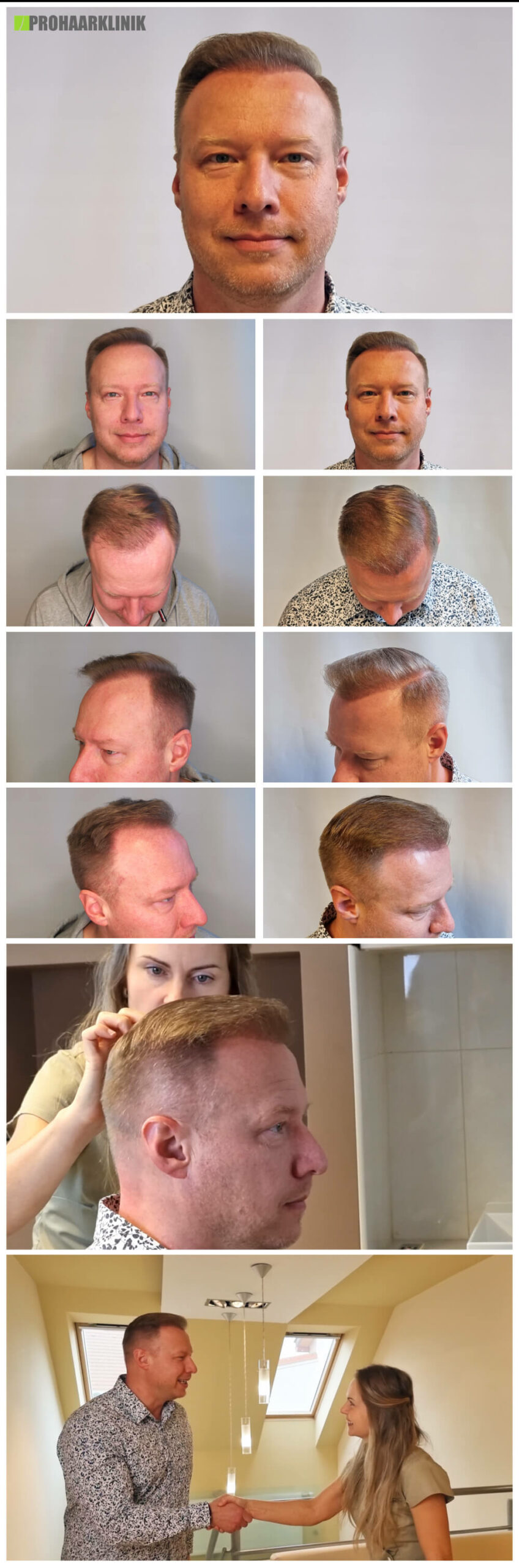 Haartransplantation vorher-nachher (Pavel) - PROHAARKLINIK