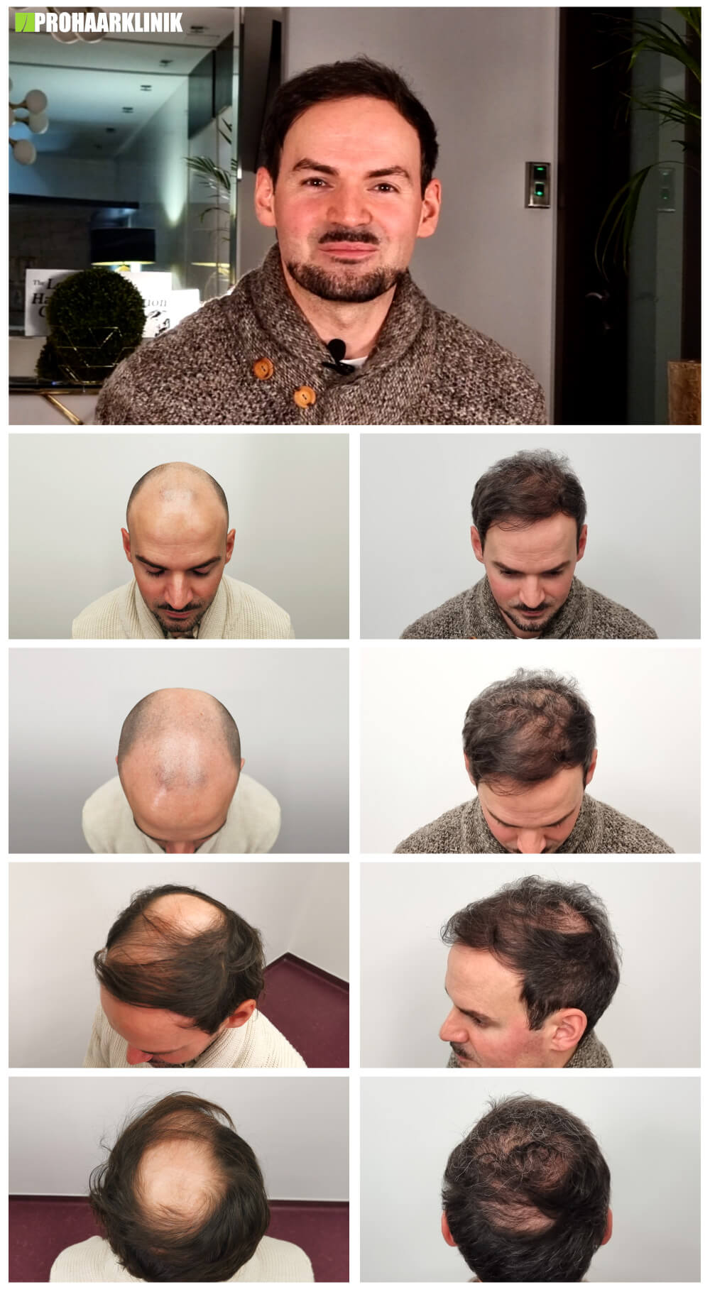 Haartransplantation Vorher Nachher