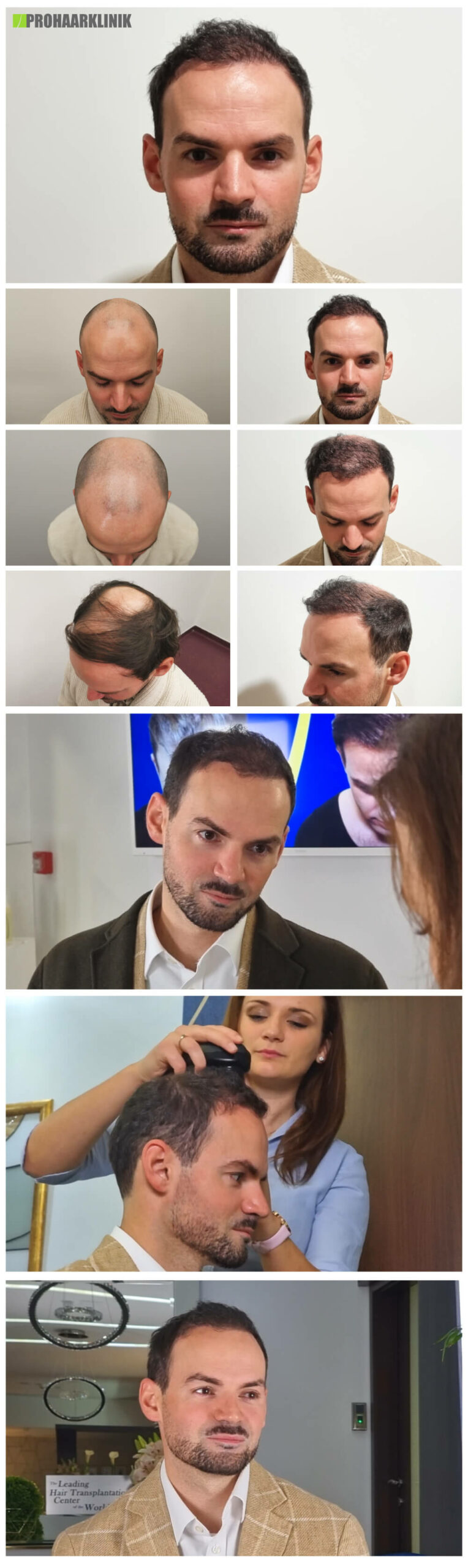 Haartransplantation vorher nachher (Tamas) - PROHAARKLINIK für Haartransplantation