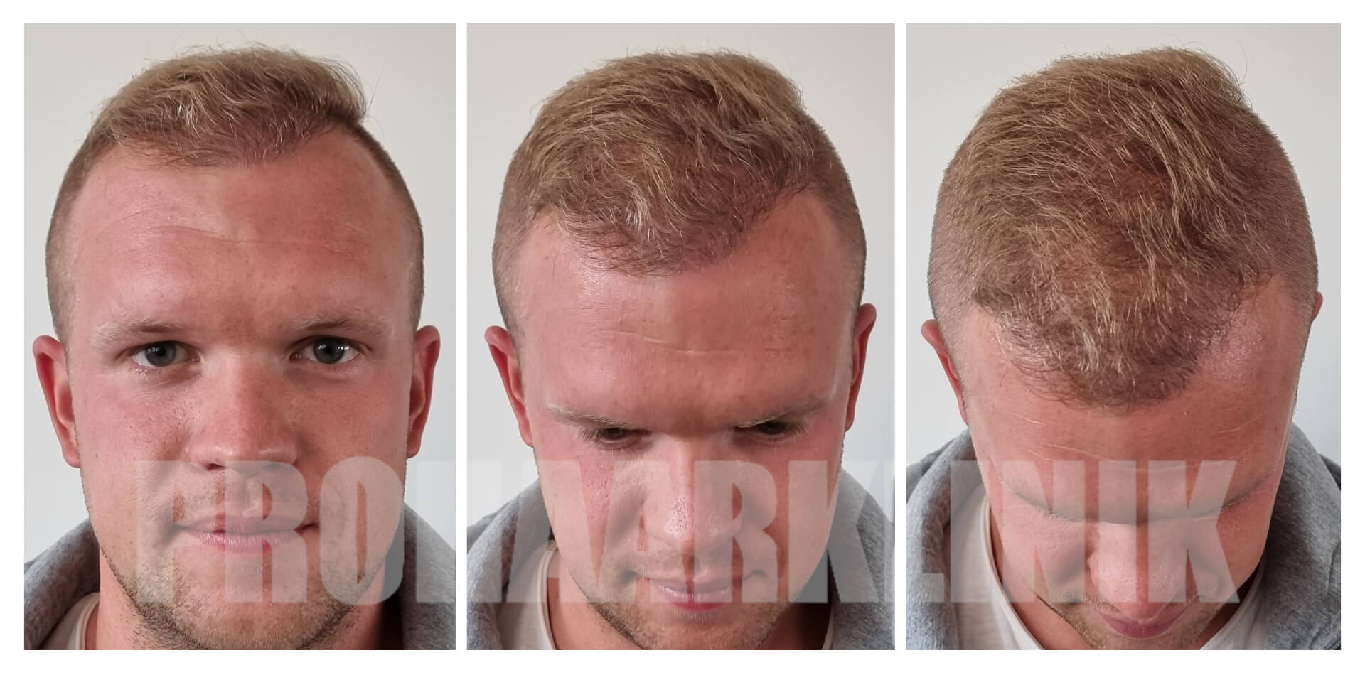 7 Monate nach der Haartransplantation: Patrik - PROHAARKLINIK