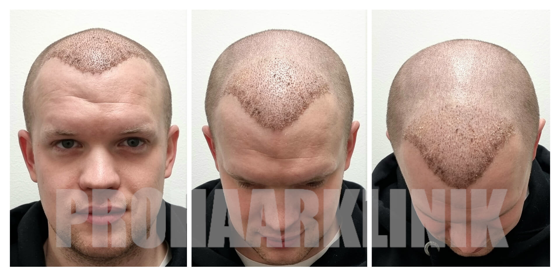 Die erste Woche nach der Haartransplantation: Erfolgreiche Genesung mit der PROHAARKLINIK