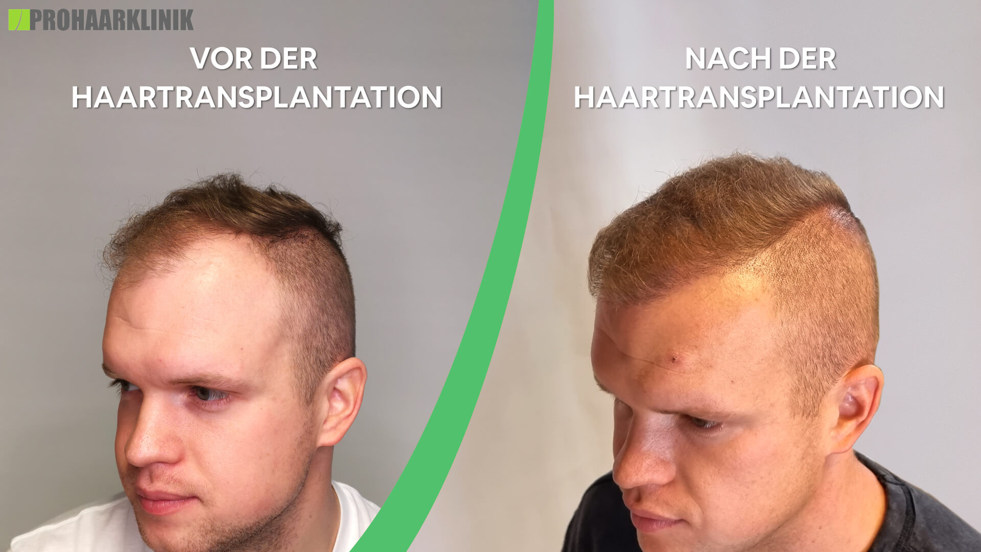 Haartransplantation vorher nachher: Patrik - PROHAARKLINIK