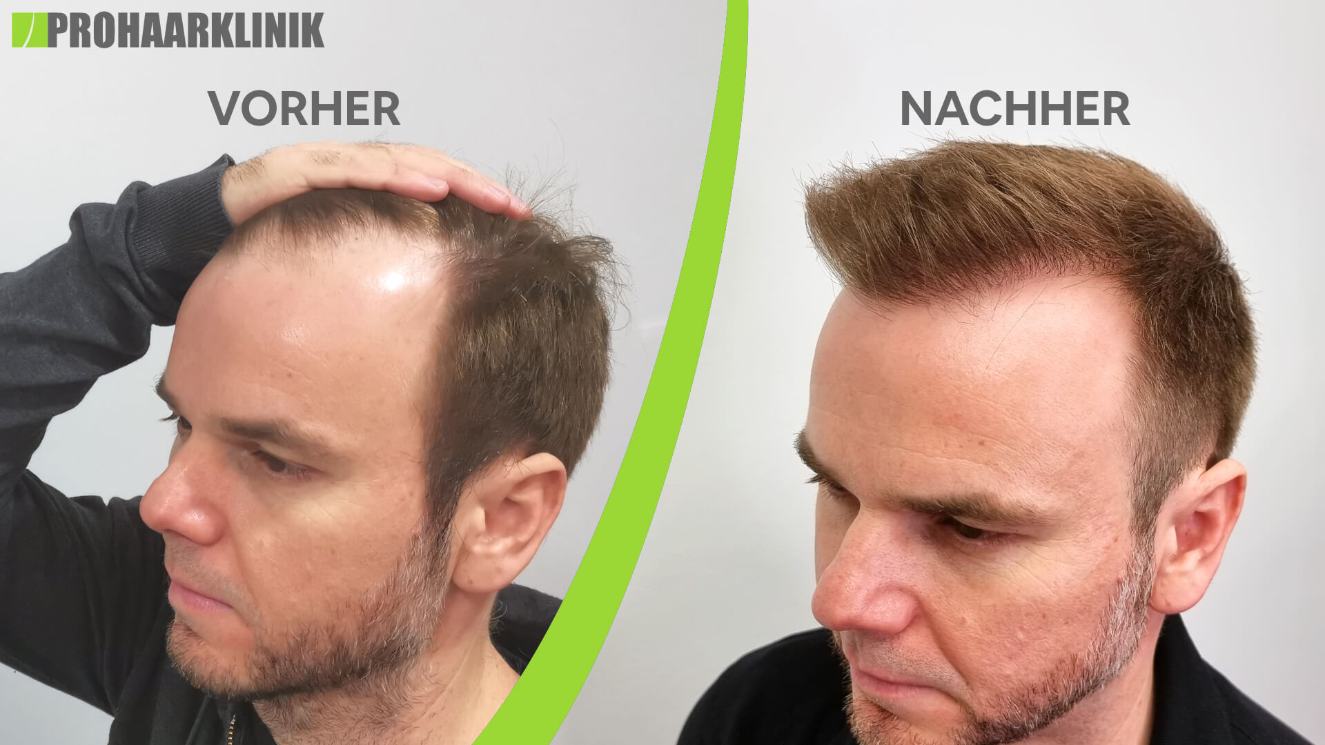 Sport nach Haartransplantation - PROHAARKLINIK nahe Wien
