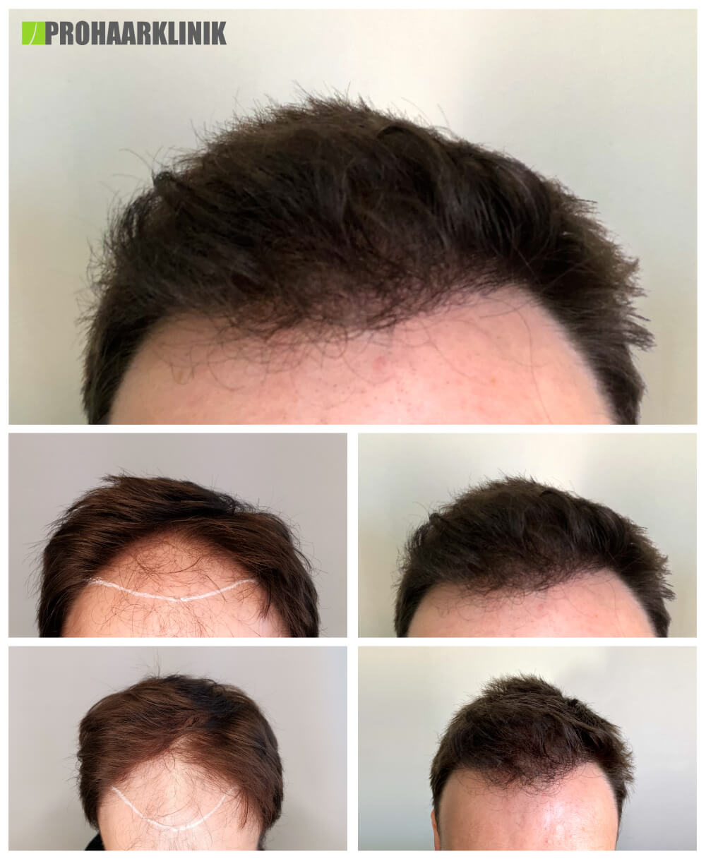 Haartransplantation vorher-nachher: Juraj - PROHAARKLINIK