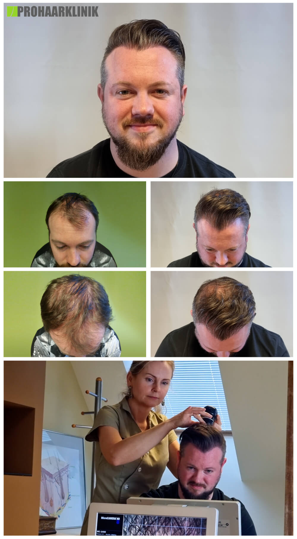 Haartransplantation vorher nachher: Christoph - PROHAARKLINIK nahe Wien