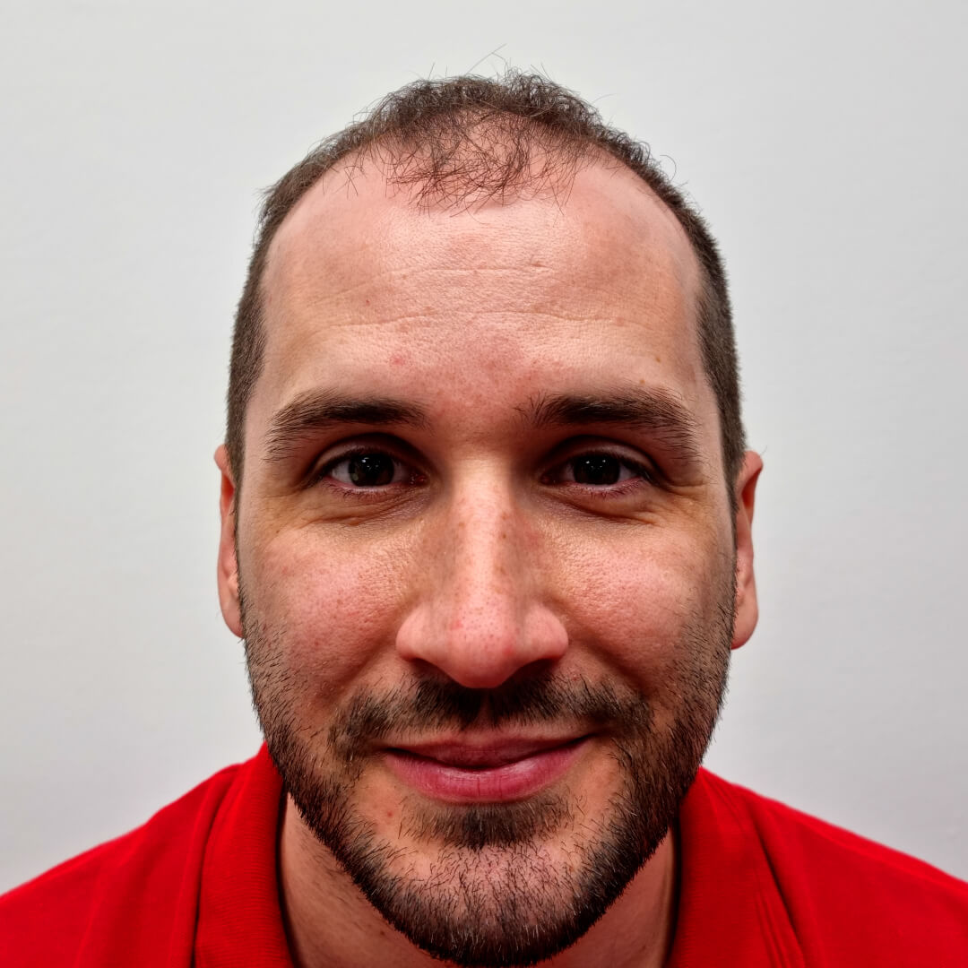 Haartransplantation vorher-nachher: Norbert - PROHAARKLINIK