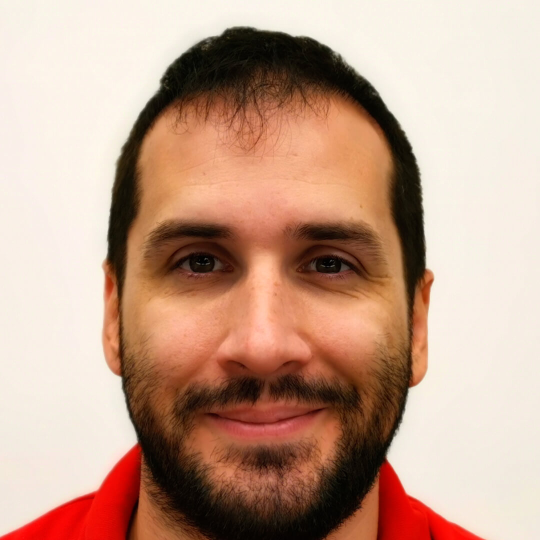 Haartransplantation vorher-nachher: Norbert - PROHAARKLINIK