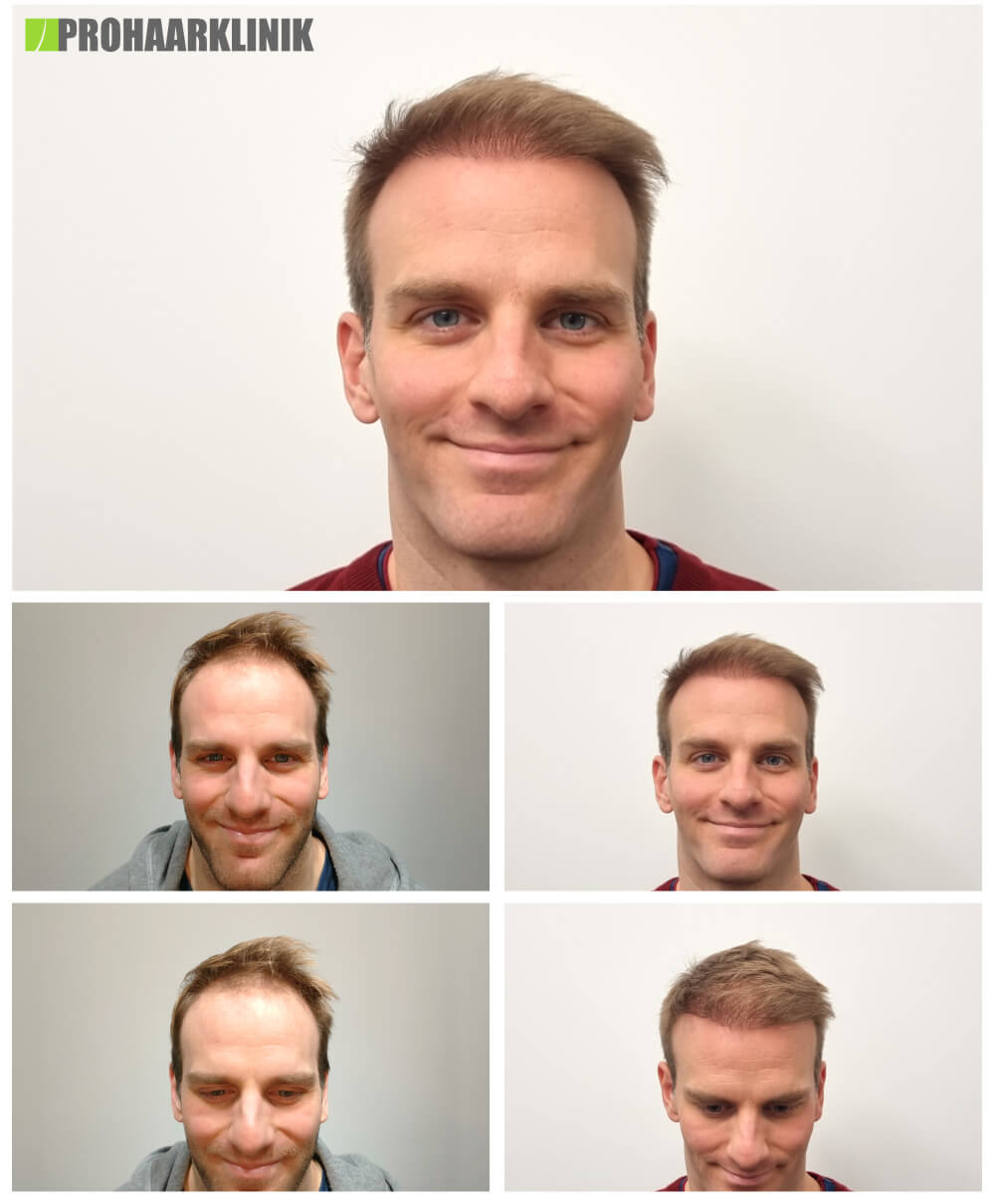 Haartransplantation vorher-nachher: Lénárd - PROHAARKLINIK