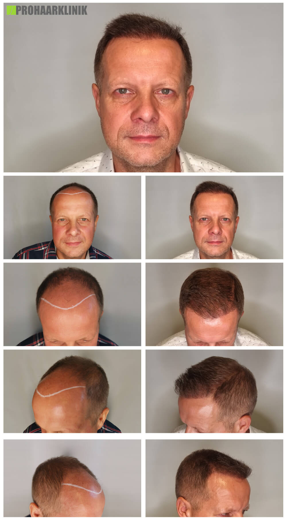 Haartransplantation vorher-nachher: Marcel - PROHAARKLINIK für Haartransplantation
