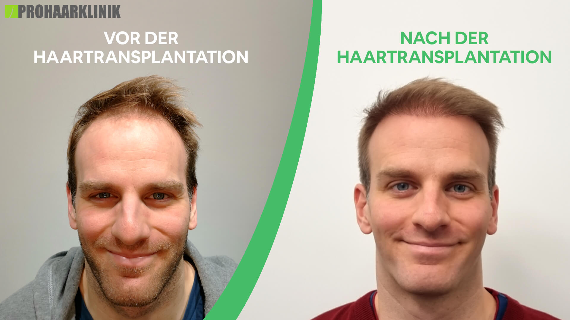 Haartransplantation vorher-nachher: Lénárd - PROHAARKLINIK nahe Wien