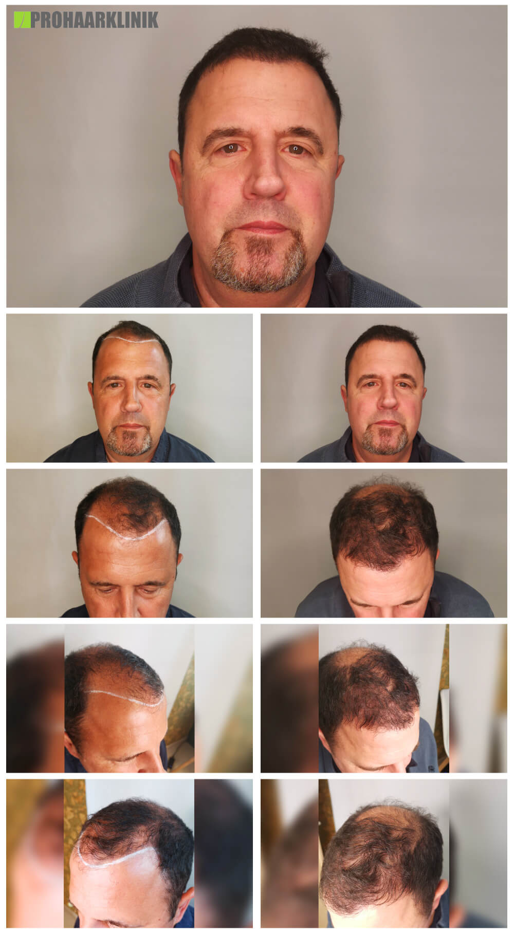 Haartransplantation vorher-nachher: Günther - PROHAARKLINIK nahe Wien