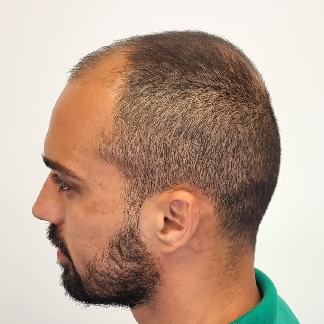 Haartransplantation vorher-nachher: Lucas- PROHAARKLINIK für Haartransplantation