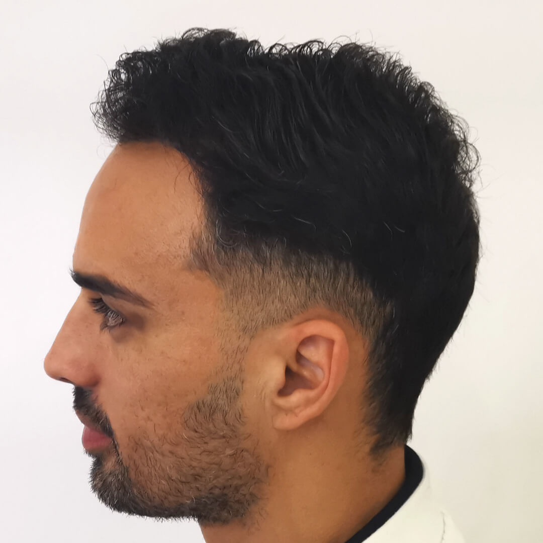 Haartransplantation vorher-nachher: Lucas- PROHAARKLINIK für Haartransplantation