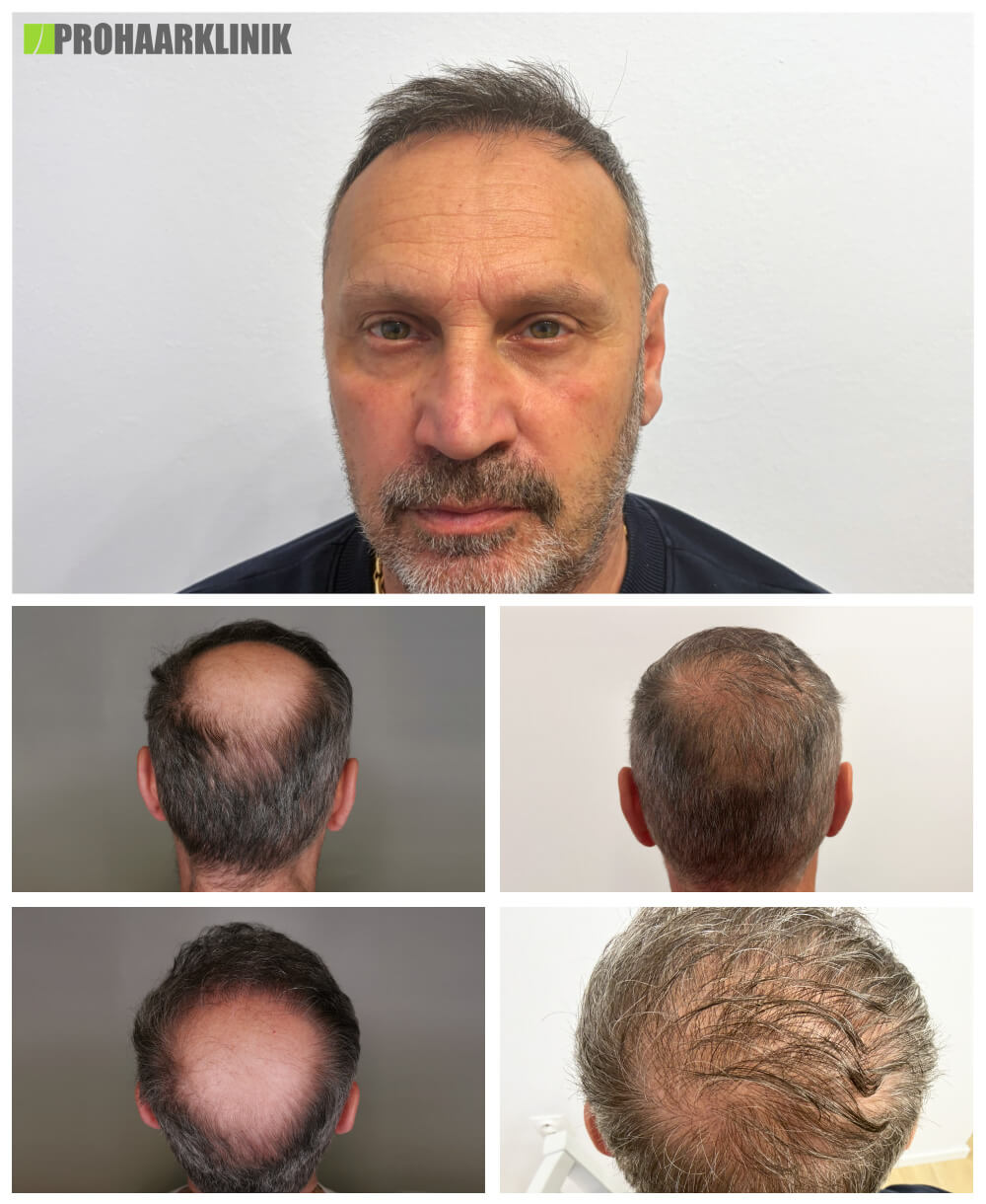 Haartransplantation vorher-nachher: Robert - PROHAARKLINIK für Haartransplantation