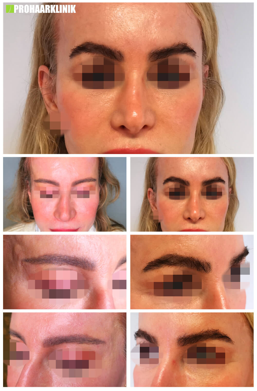 Augenbrauentransplantation vorher-nachher: Andrea - PROHAARKLINIK