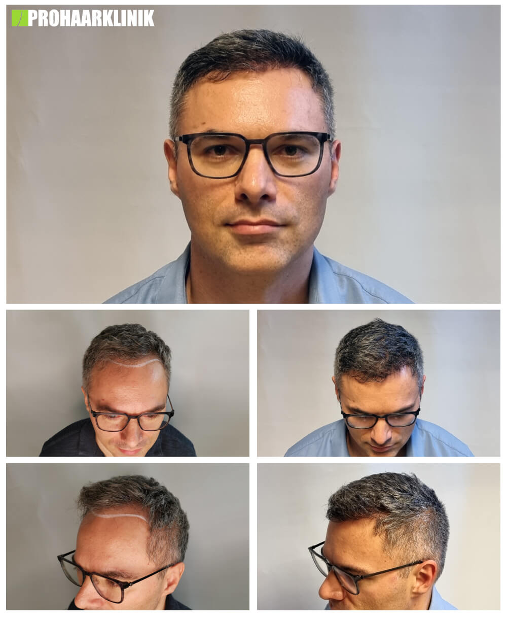 Haartransplantation vorher-nachher: Pavel - PROHAARKLINIK nahe Wien