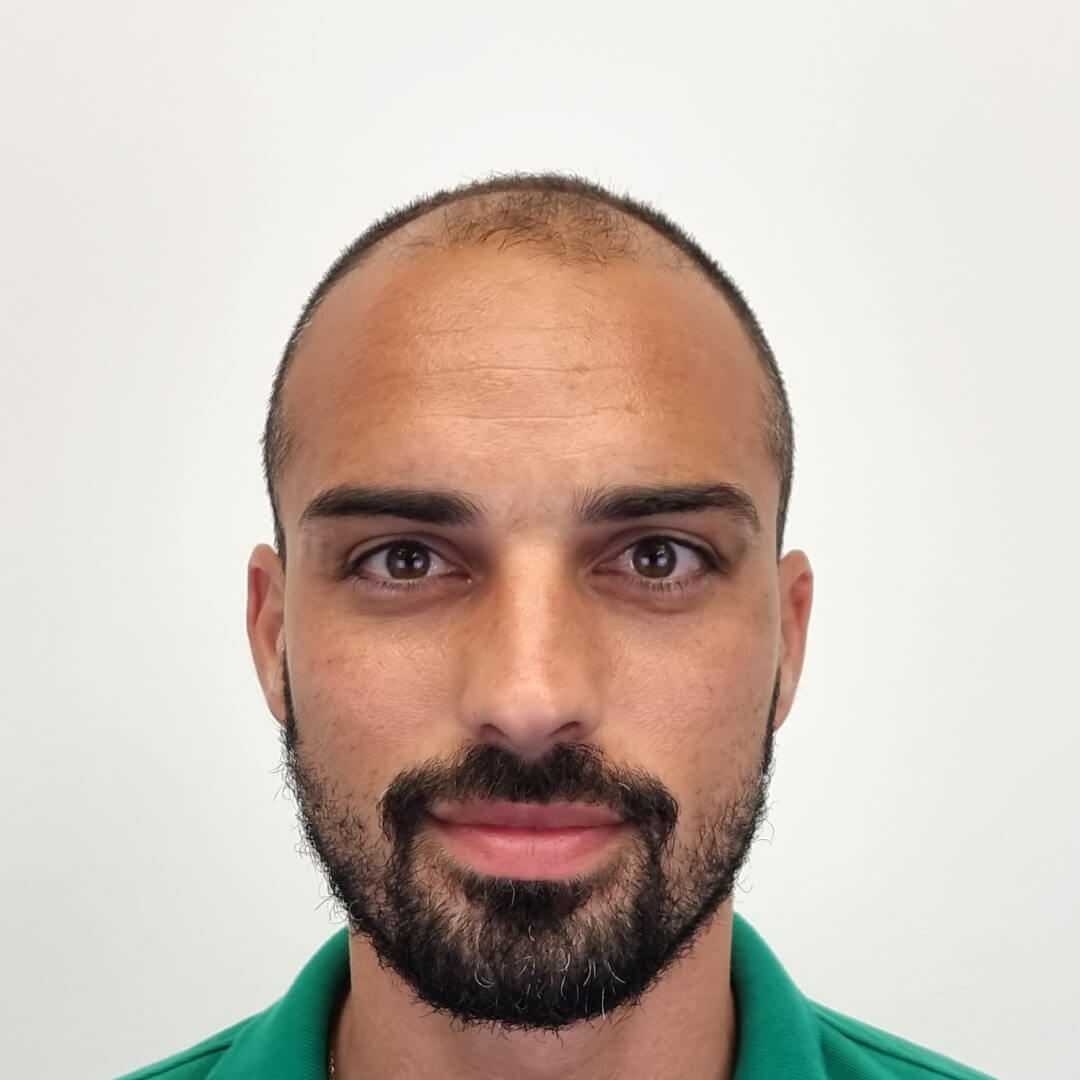 Haartransplantation vorher-nachher: Lucas - PROHAARKLINIK nahe Wien