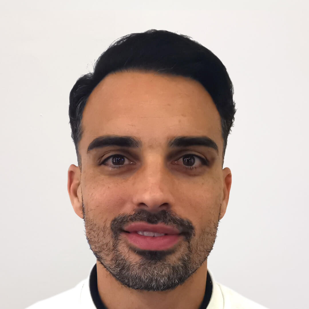 Haartransplantation vorher-nachher: Lucas - PROHAARKLINIK nahe Wien