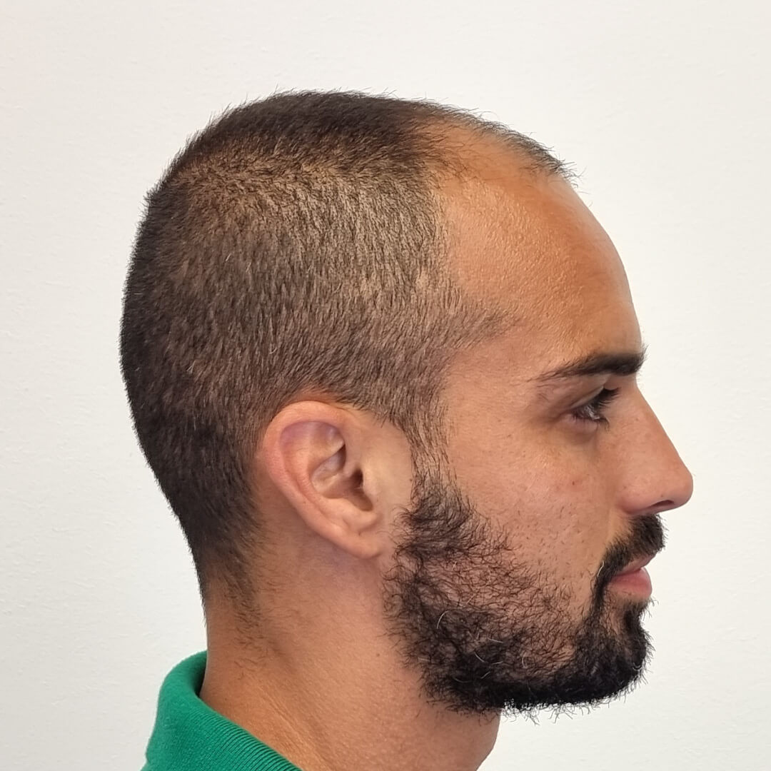 Haartransplantation vorher-nachher: Lucas - PROHAARKLINIK nahe Wien