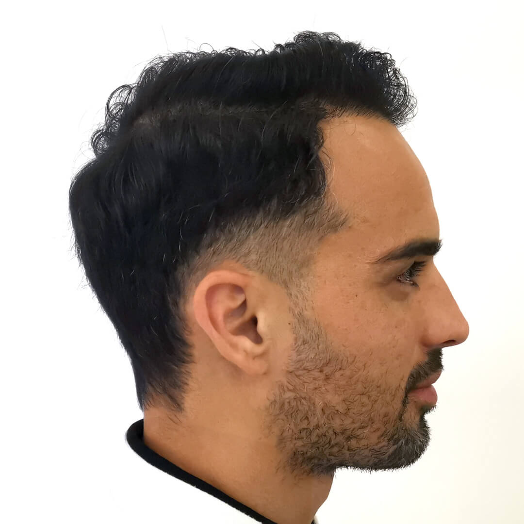 Haartransplantation vorher-nachher: Lucas - PROHAARKLINIK nahe Wien