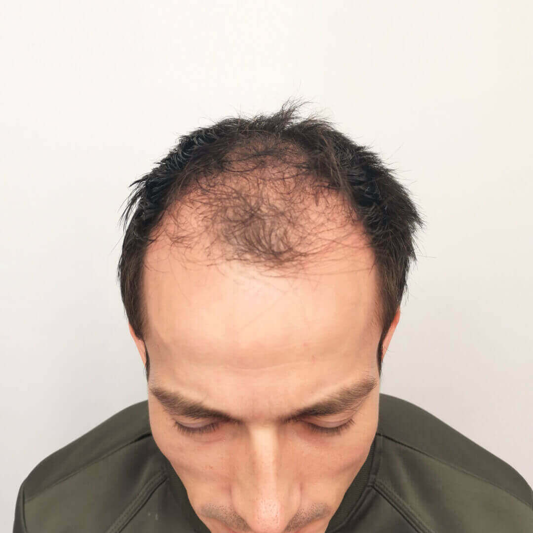 Haartransplantation vorher-nachher: Gregor - PROHAARKLINIK