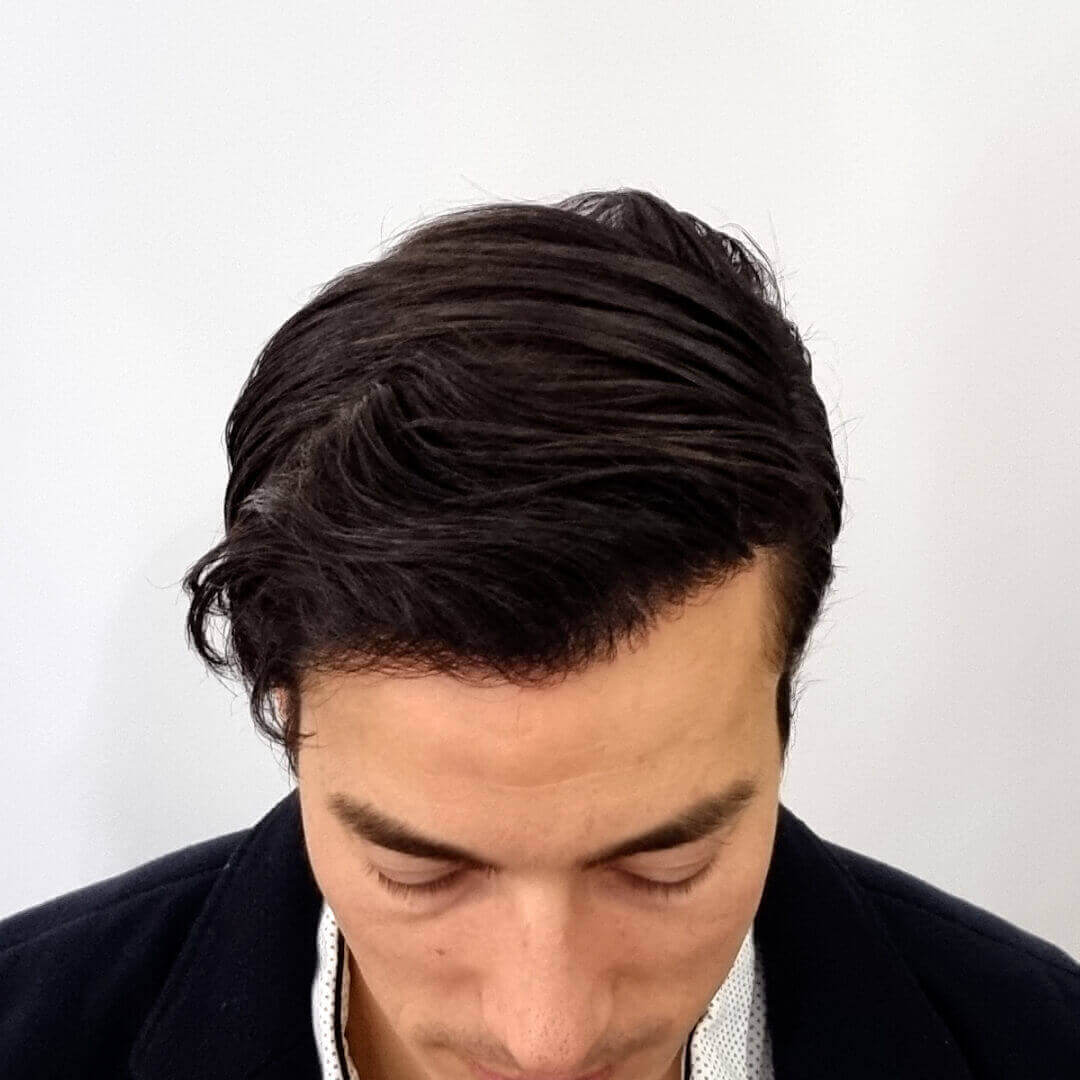 Haartransplantation vorher-nachher: Gregor - PROHAARKLINIK