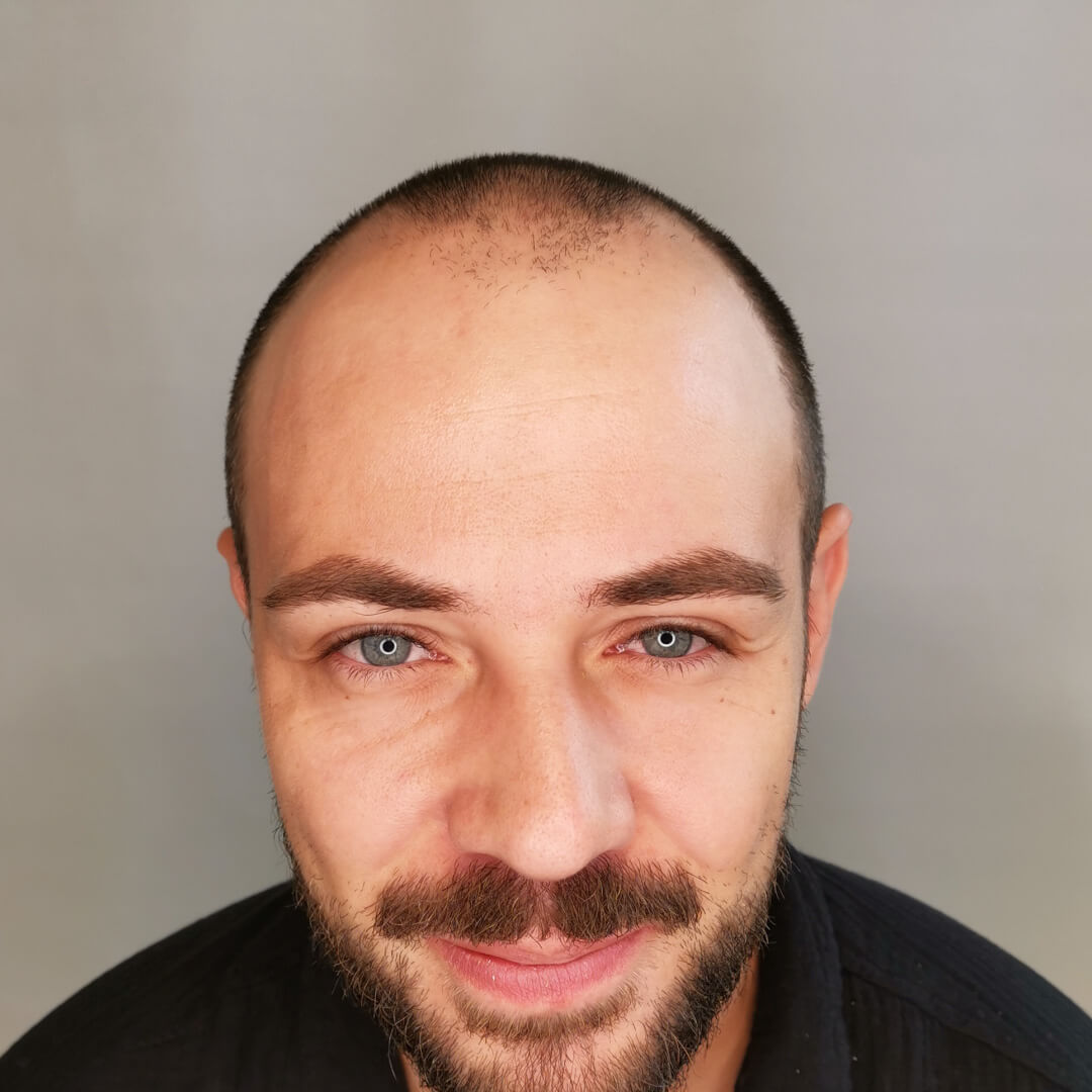 Haartransplantation erfahrungen – Mario